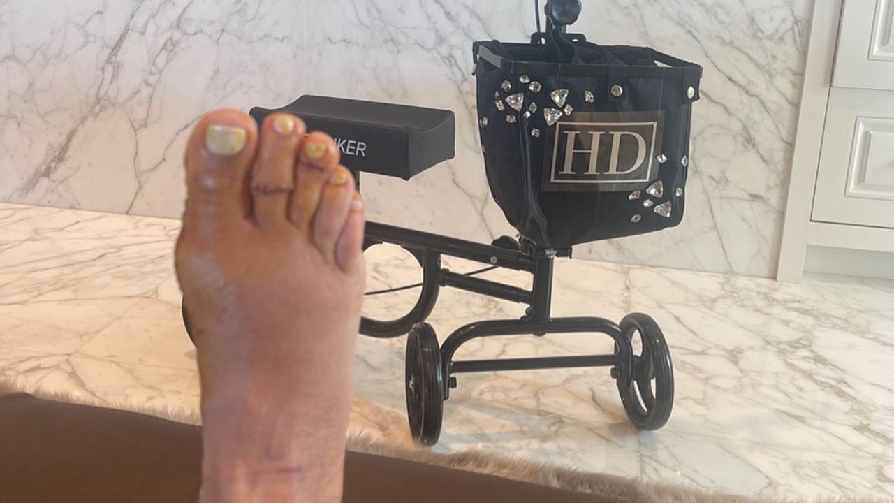 heather dubrow foot surgery (bunion surgery)